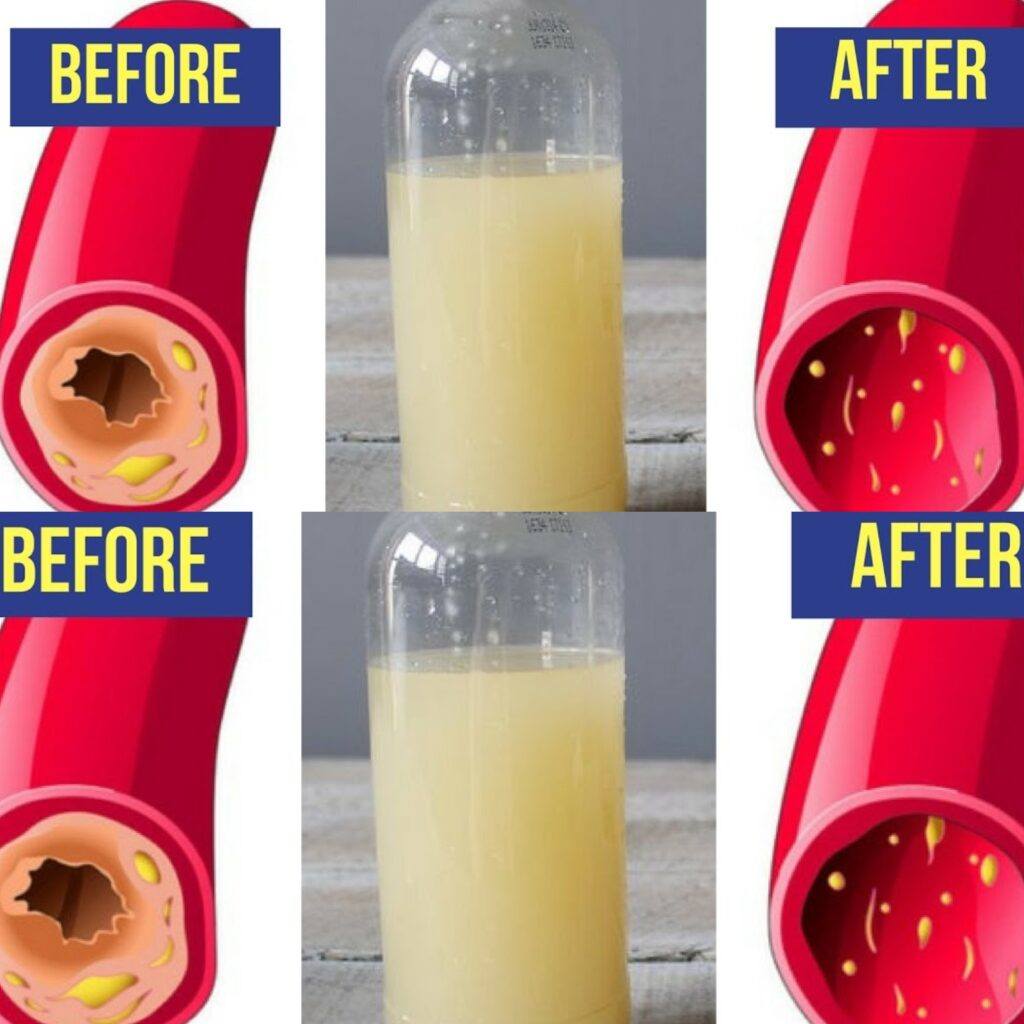 Can Apple Cider Vinegar Remove Plaque From Arteries A Glass of This Juice Everyday Will Remove Clogged Arteries and Control